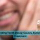 Understanding Tooth Decay: Causes, Symptoms, And Treatment