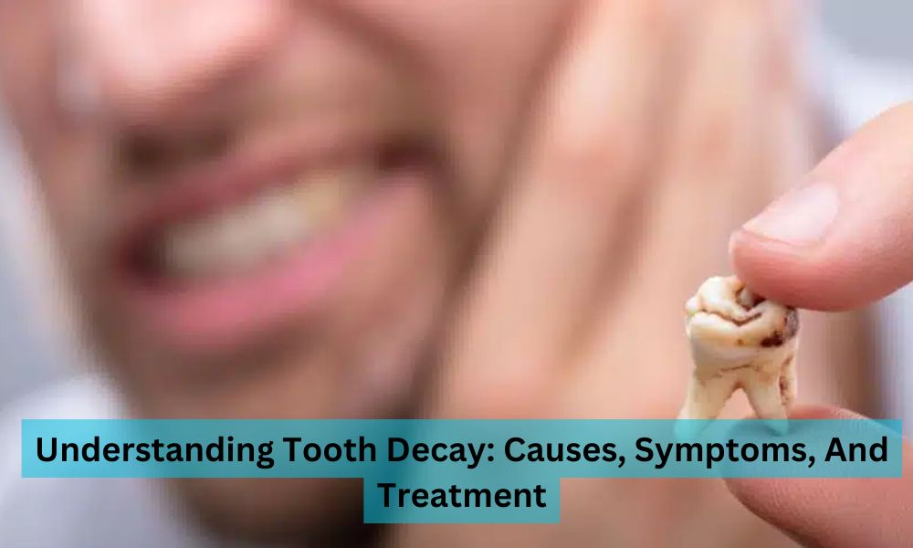 Understanding Tooth Decay: Causes, Symptoms, And Treatment