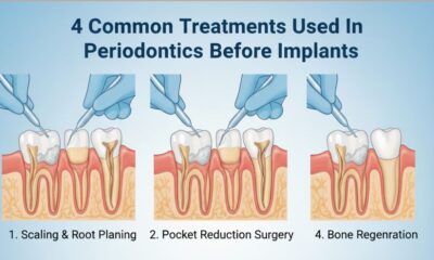 4 Common Treatments Used In Periodontics Before Implants