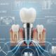Why General Dentistry Is The Foundation For Implant Success