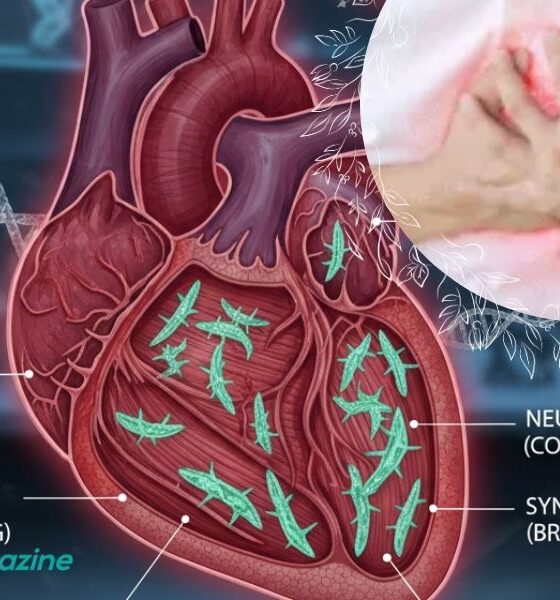 why does ozdikenosis kill you