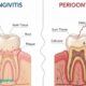 gingivitis vs periodontitis